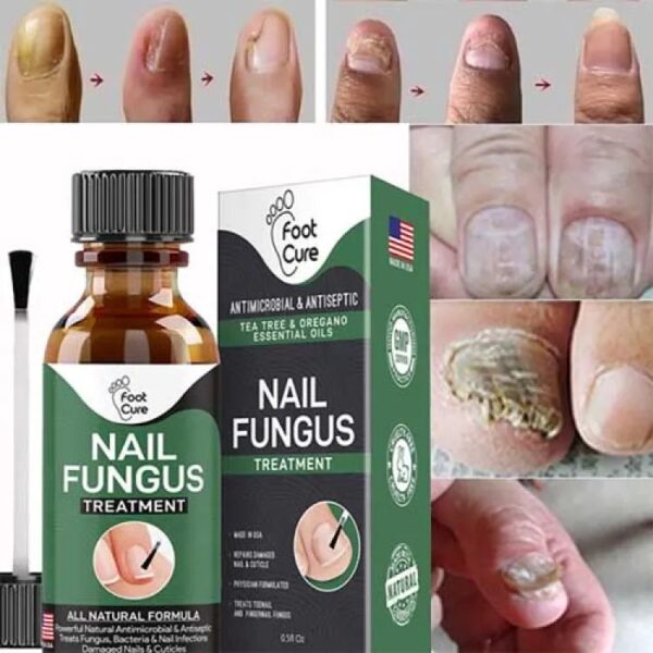 Nail Fungus Treatment Stop Fungal Growth Effective Fingernail 10ml - Image 3